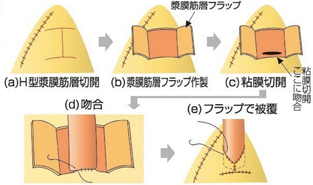 全食道悪性手術の症例数を術式の推移