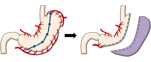 腹腔鏡下スリーブ状（袖状）胃切除術
