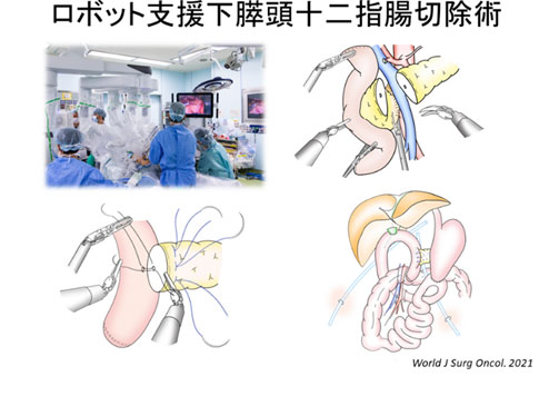 ロボット支援下膵頭十二指腸切除術